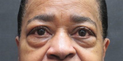 Eyelid Surgery Before & After Patient #11907