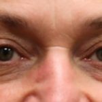 Eyelid Surgery Before & After Patient #11908