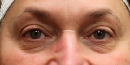 Eyelid Surgery Before & After Patient #11908