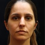Rhinoplasty Before & After Patient #11947