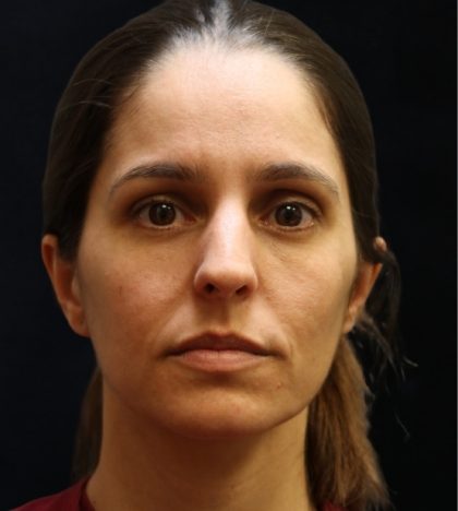 Rhinoplasty Before & After Patient #11947