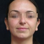 Rhinoplasty Before & After Patient #11948