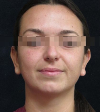 Rhinoplasty Before & After Patient #11948