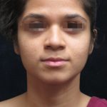 Rhinoplasty Before & After Patient #11949