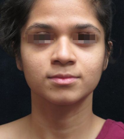 Rhinoplasty Before & After Patient #11949