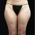 Liposuction Before & After Patient #11547
