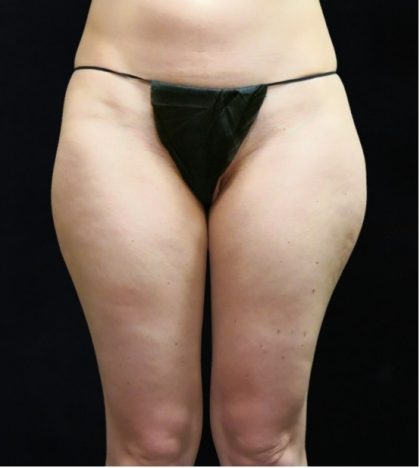 Liposuction Before & After Patient #11547
