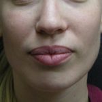 Rhinoplasty Before & After Patient #11950