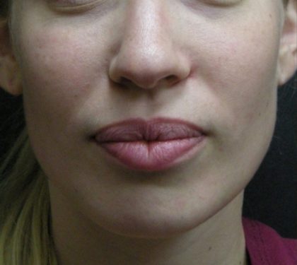 Rhinoplasty Before & After Patient #11950