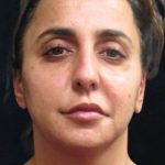 Rhinoplasty Before & After Patient #11951
