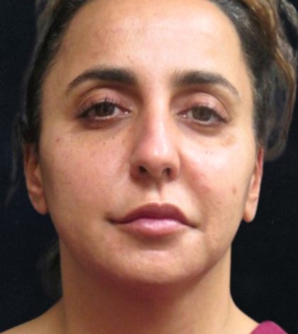 Rhinoplasty Before & After Patient #11951
