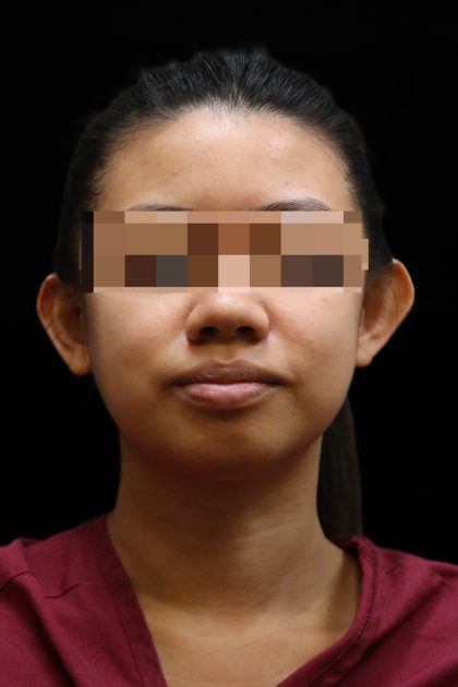 Ear Reshaping Before & After Patient #12011