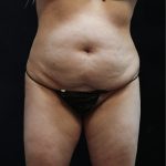 Liposuction Before & After Patient #11548