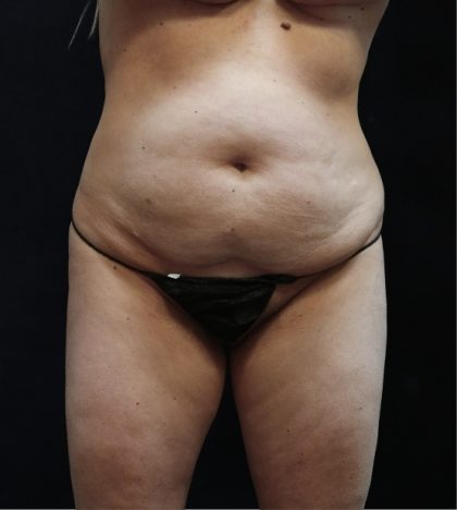 Liposuction Before & After Patient #11548