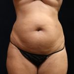 Liposuction Before & After Patient #11549