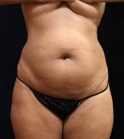 Liposuction Before & After Patient #11549