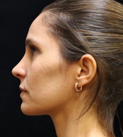 Rhinoplasty Before & After Patient #11947