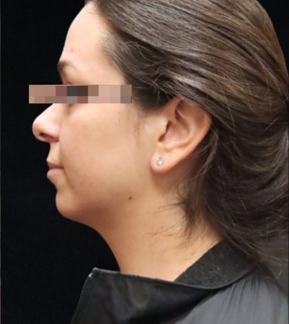 Rhinoplasty Before & After Patient #11948