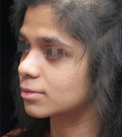 Rhinoplasty Before & After Patient #11949