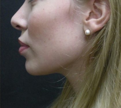 Rhinoplasty Before & After Patient #11950