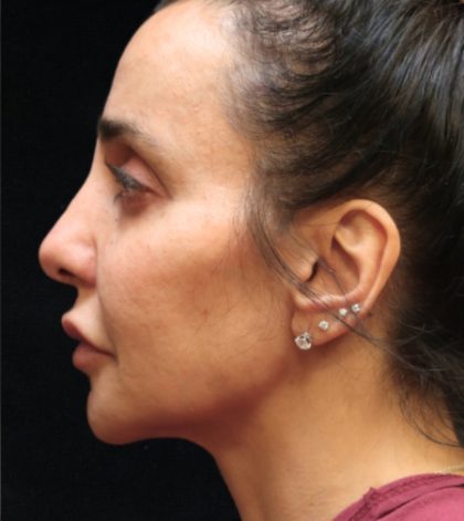 Rhinoplasty Before & After Patient #11951