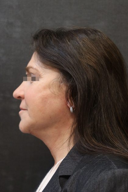 Facelift Before & After Patient #11660