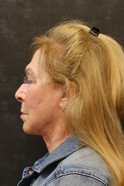 Facelift Before & After Patient #11662
