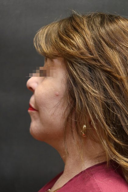 Facelift Before & After Patient #11663