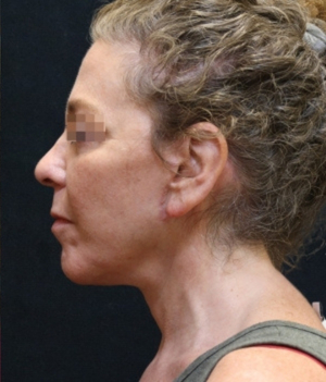 Levinelift Before & After Patient #11787