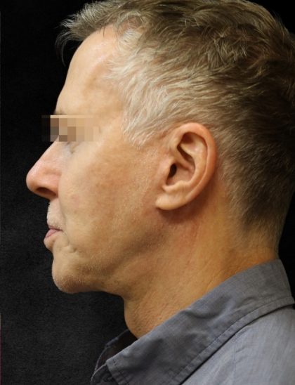 Levinelift Before & After Patient #11789