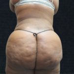 Liposuction Before & After Patient #11550