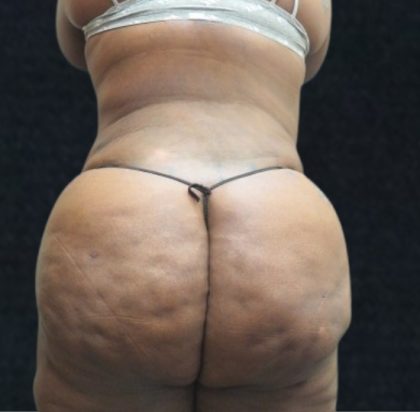 Liposuction Before & After Patient #11550
