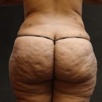 Liposuction Before & After Patient #11551
