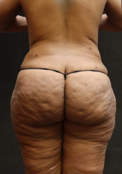 Liposuction Before & After Patient #11551