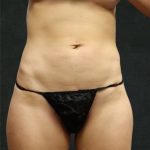Liposuction Before & After Patient #11552