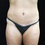 Liposuction Before & After Patient #11554