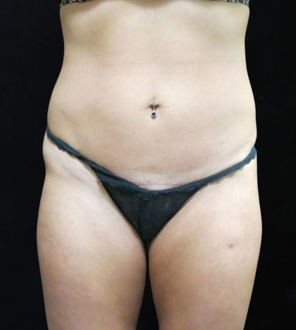 Liposuction Before & After Patient #11554
