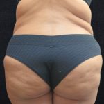 Liposuction Before & After Patient #11555