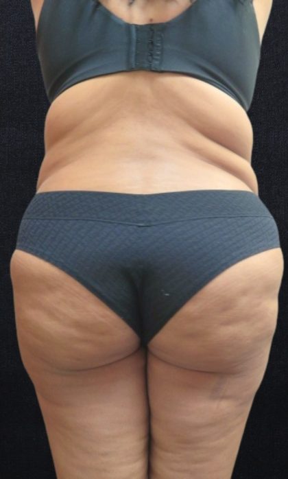 Liposuction Before & After Patient #11555