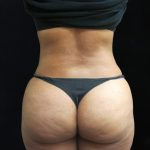 Liposuction Before & After Patient #11540
