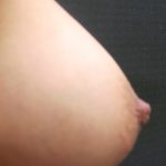 Inverted Nipple Correction Before & After Patient #11633