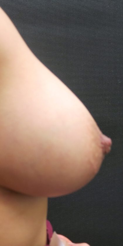 Inverted Nipple Correction Before & After Patient #11633