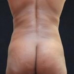 Liposuction Before & After Patient #11542