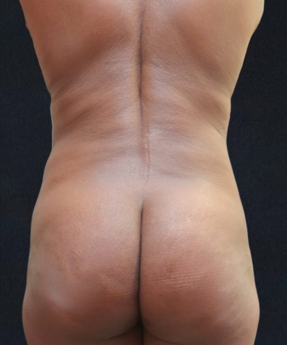 Liposuction Before & After Patient #11542
