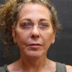 Facelift Before & After Patient #11659