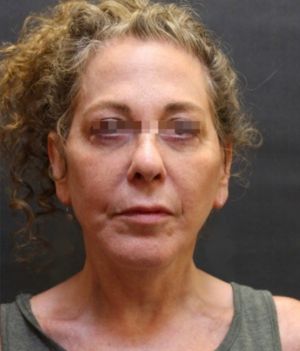 Facelift Before & After Patient #11659