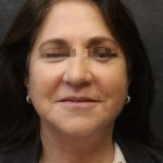 Facelift Before & After Patient #11660