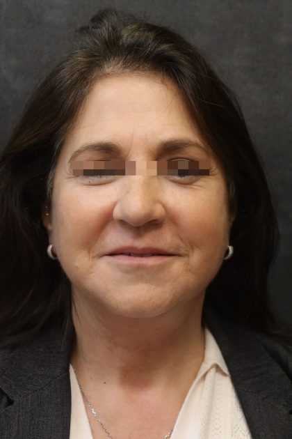 Facelift Before & After Patient #11660