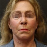 Facelift Before & After Patient #11662