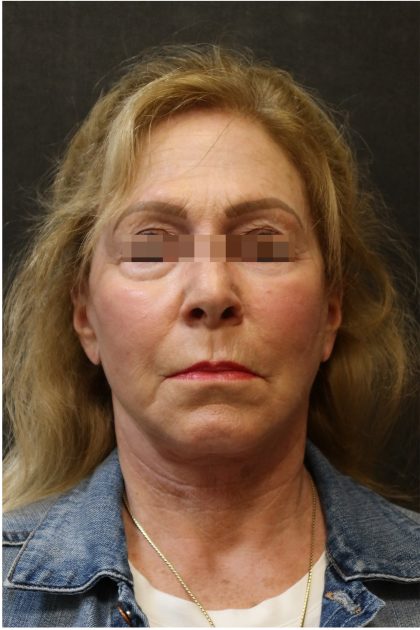 Facelift Before & After Patient #11662